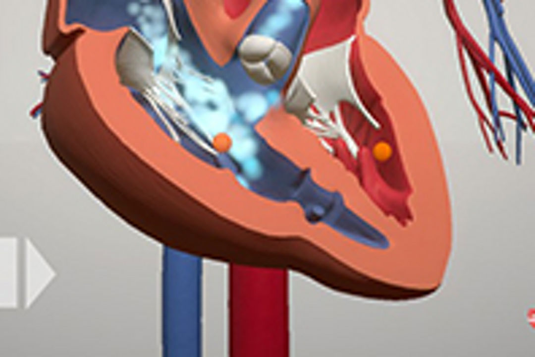 Watch how Pulmonary Atresia is treated using an interactive 3-D heart