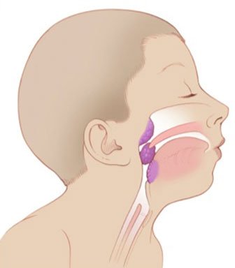 adenoids side view