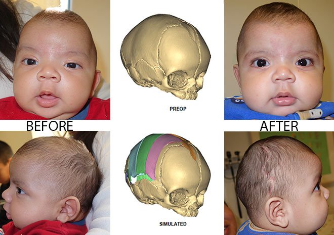 A patient and computer-simulated surgery of that patient’s skull before and after surgery for sagittal craniosynostosis.