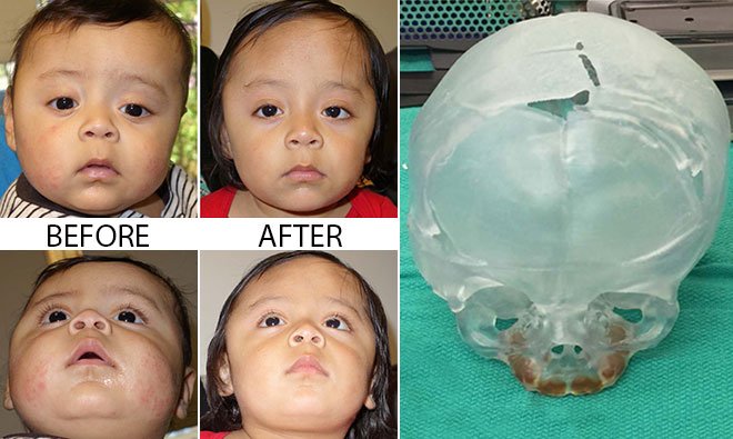 A patient with right unicoronal craniosynostosis, the patient after surgery, and the 3-D model of the patient’s desired skull shape. The models are used to guide doctors in surgery.