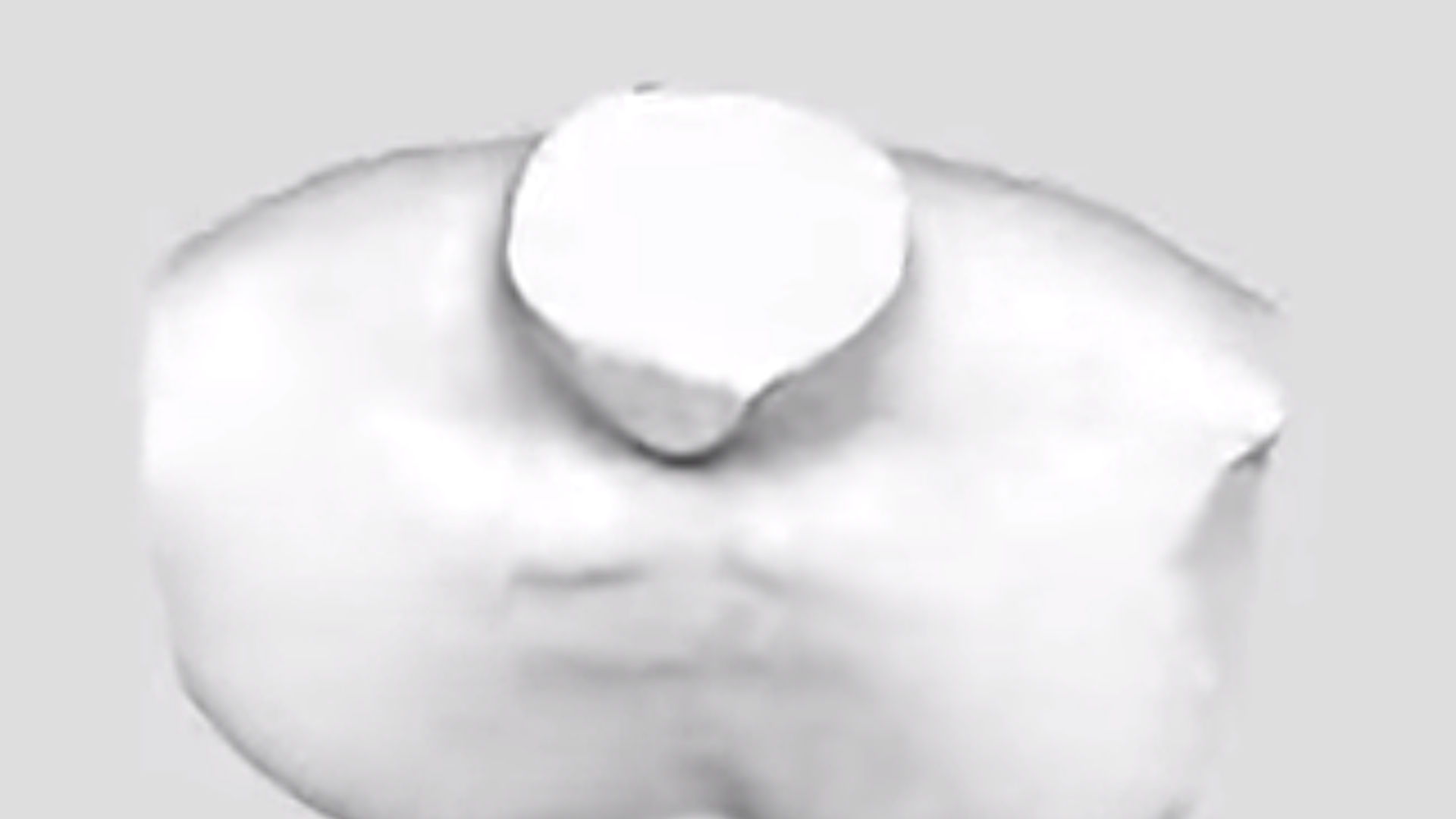 Pectus Excavatum 3-D Scan