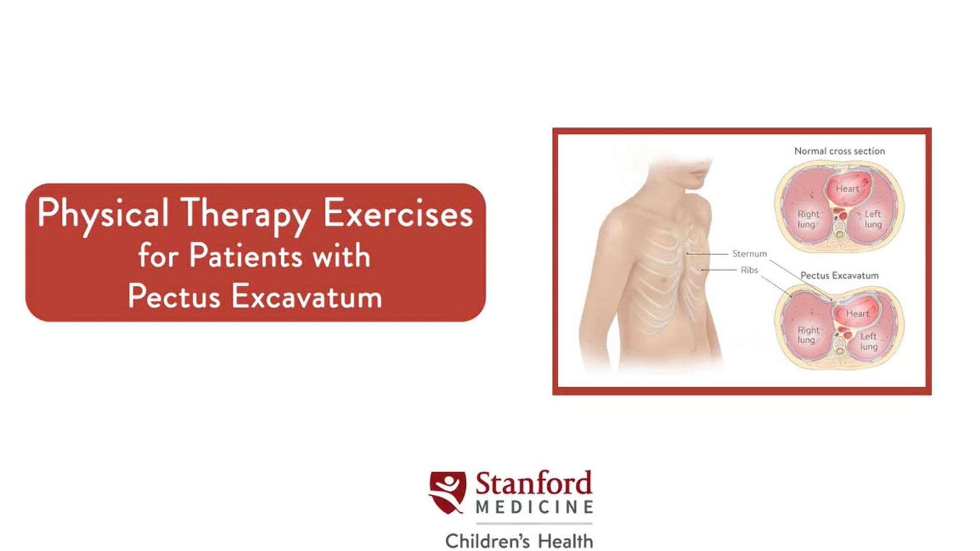 Physical therapy exercises for patients with pectus excavatum