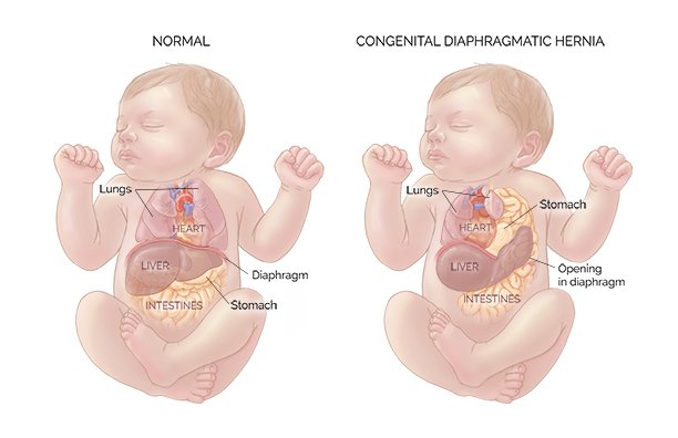 Hernia diafragmática congénita fetal