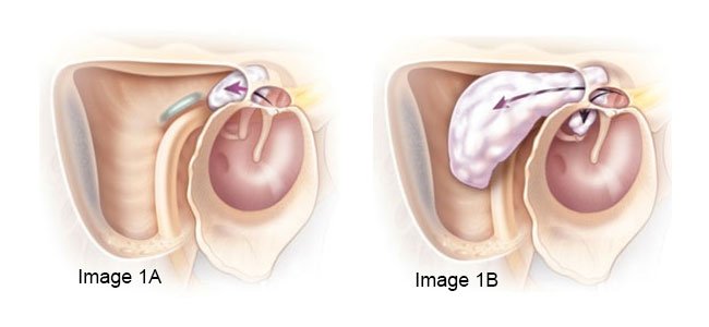cholesteatoma image 1