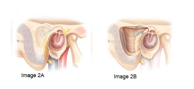 cholesteatoma image 2