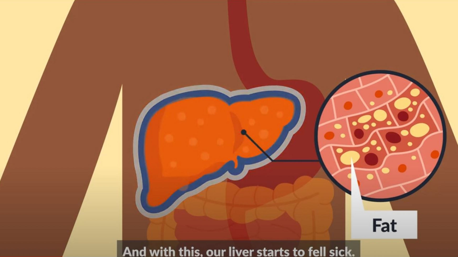 Fatty LIver Disease Nutrition - Patient Education