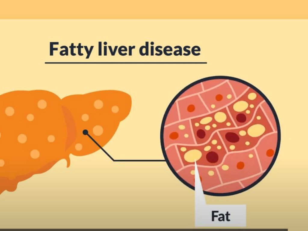 Fatty LIver Disease - Patient Education