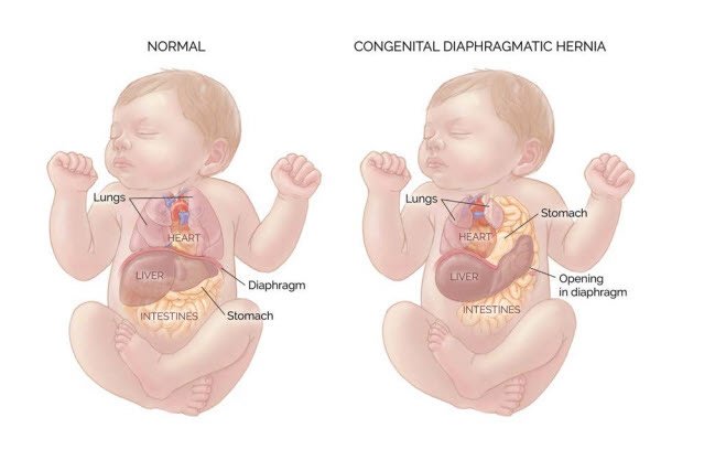 Congenital diaphragmatic hernia diagram