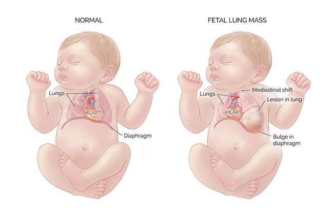 Fetal Lung Mass diagram