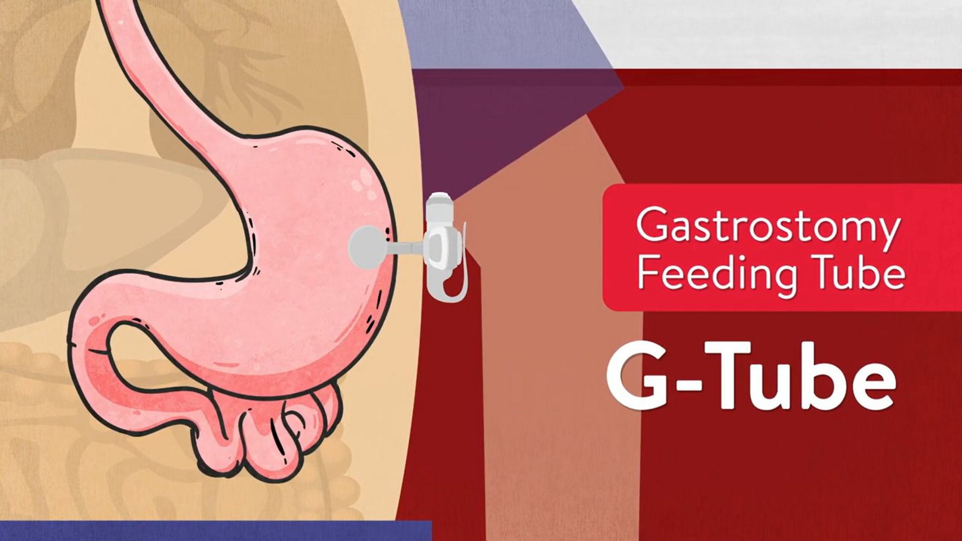 G-tube educational videos