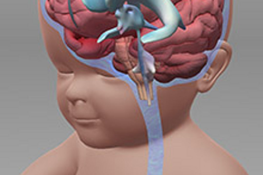 Hydrocephalus animation