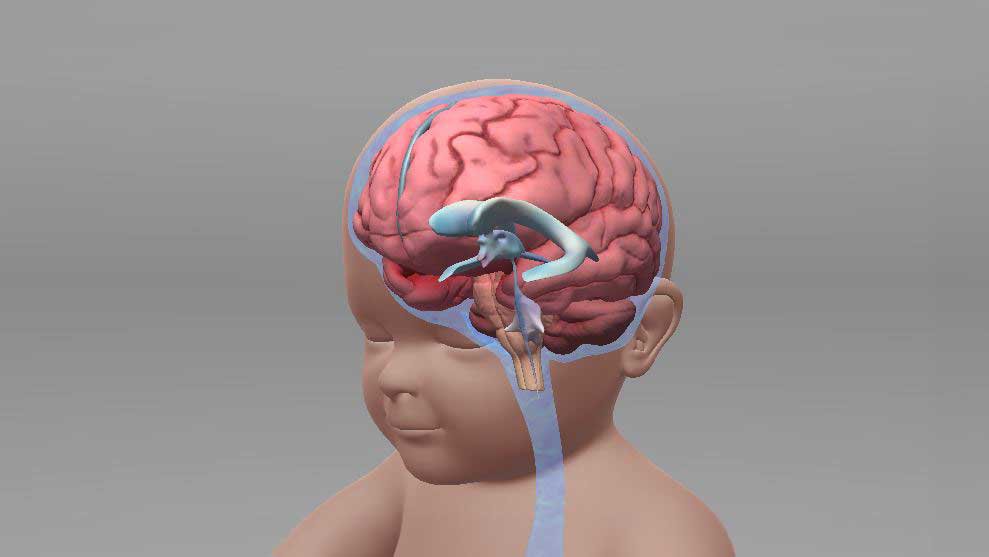 Hydrocephalus animation icon