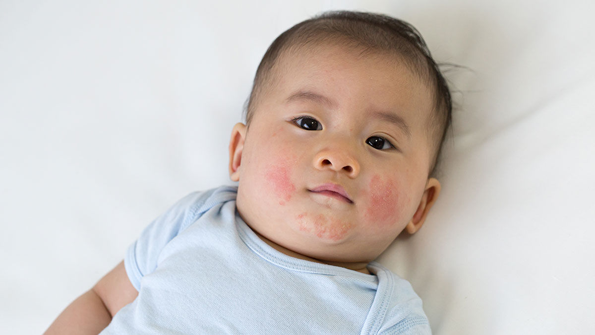 Baby with measles 