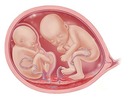 Monochorionic twins diagram