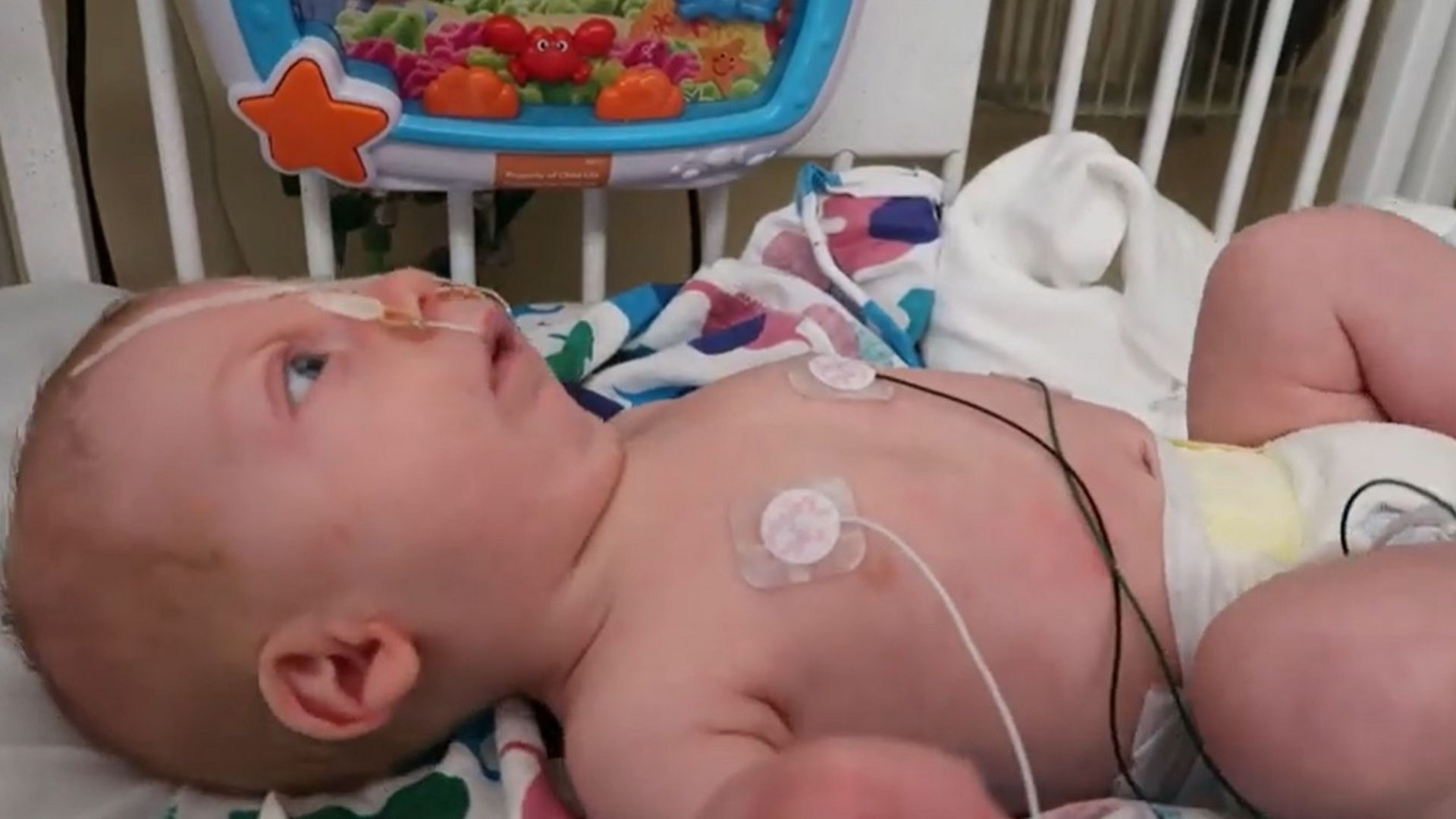 A baby breathing 2 days with Stanford OAP