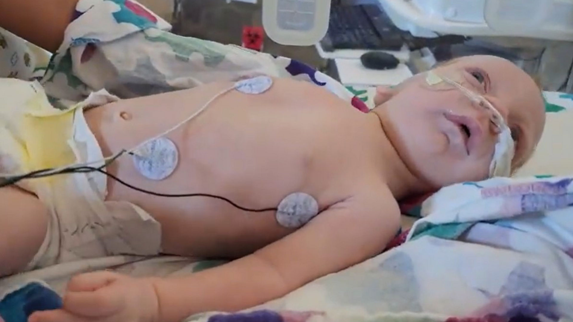 A baby breathing before Stanford OAP