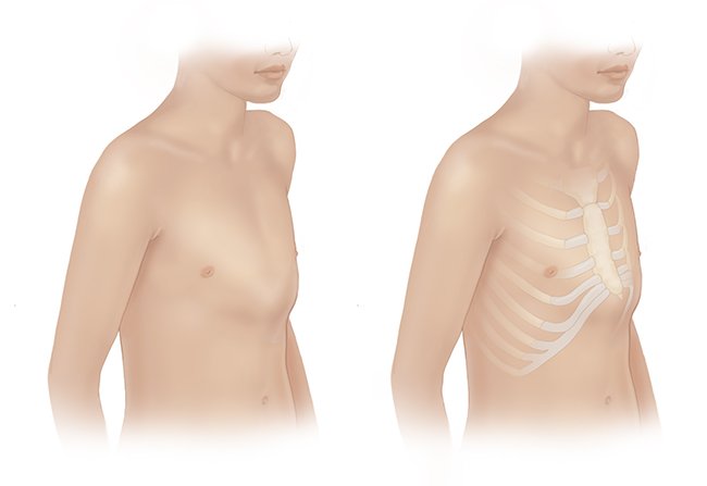Pectus Excavatum