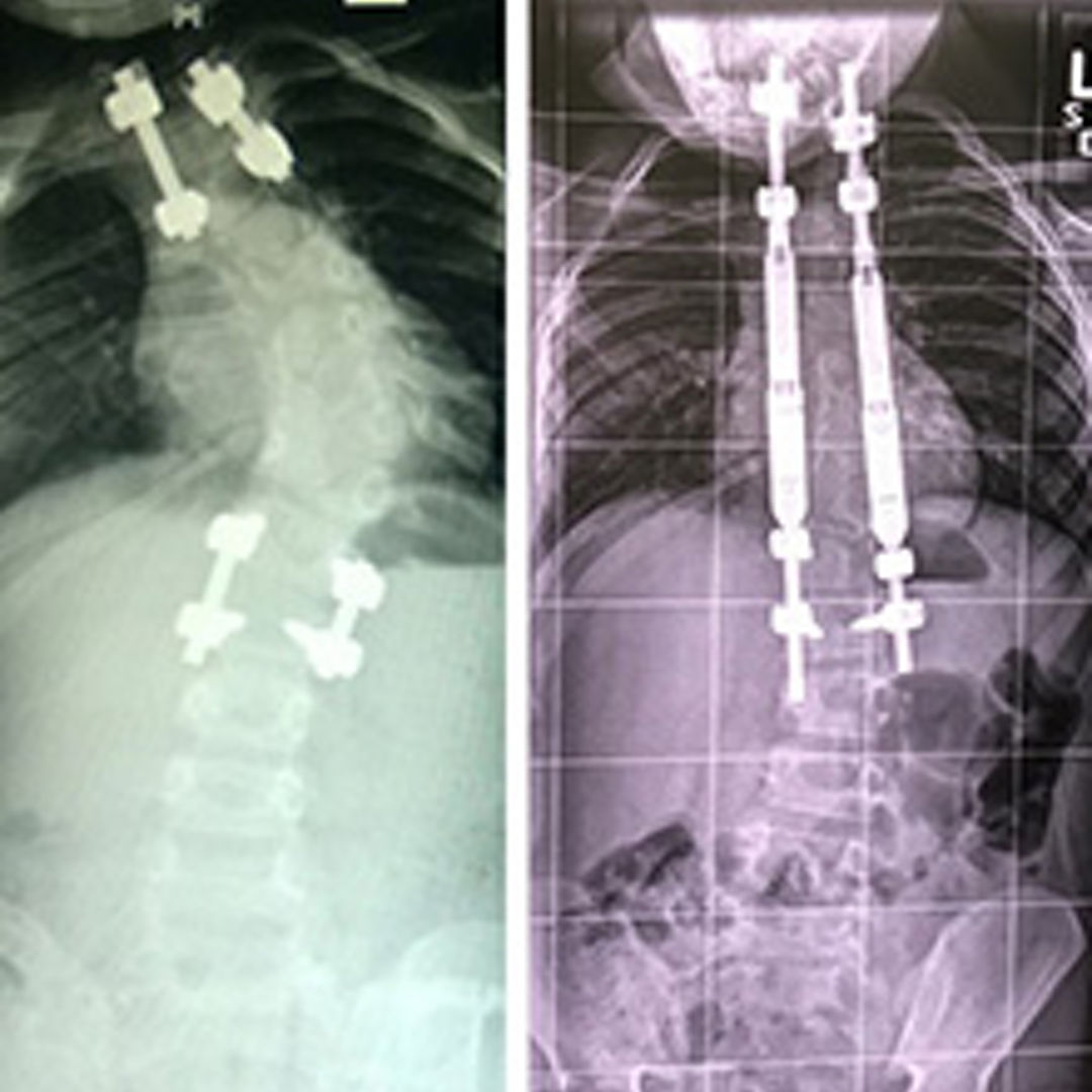 Spine x-ray