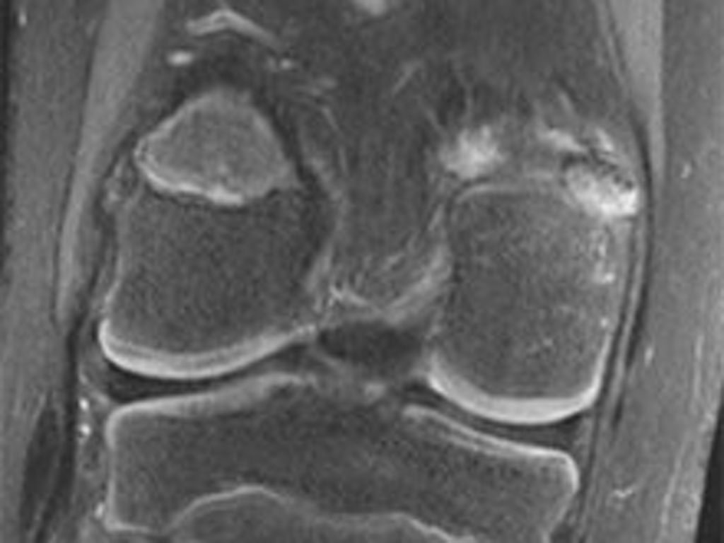 MRI knee image