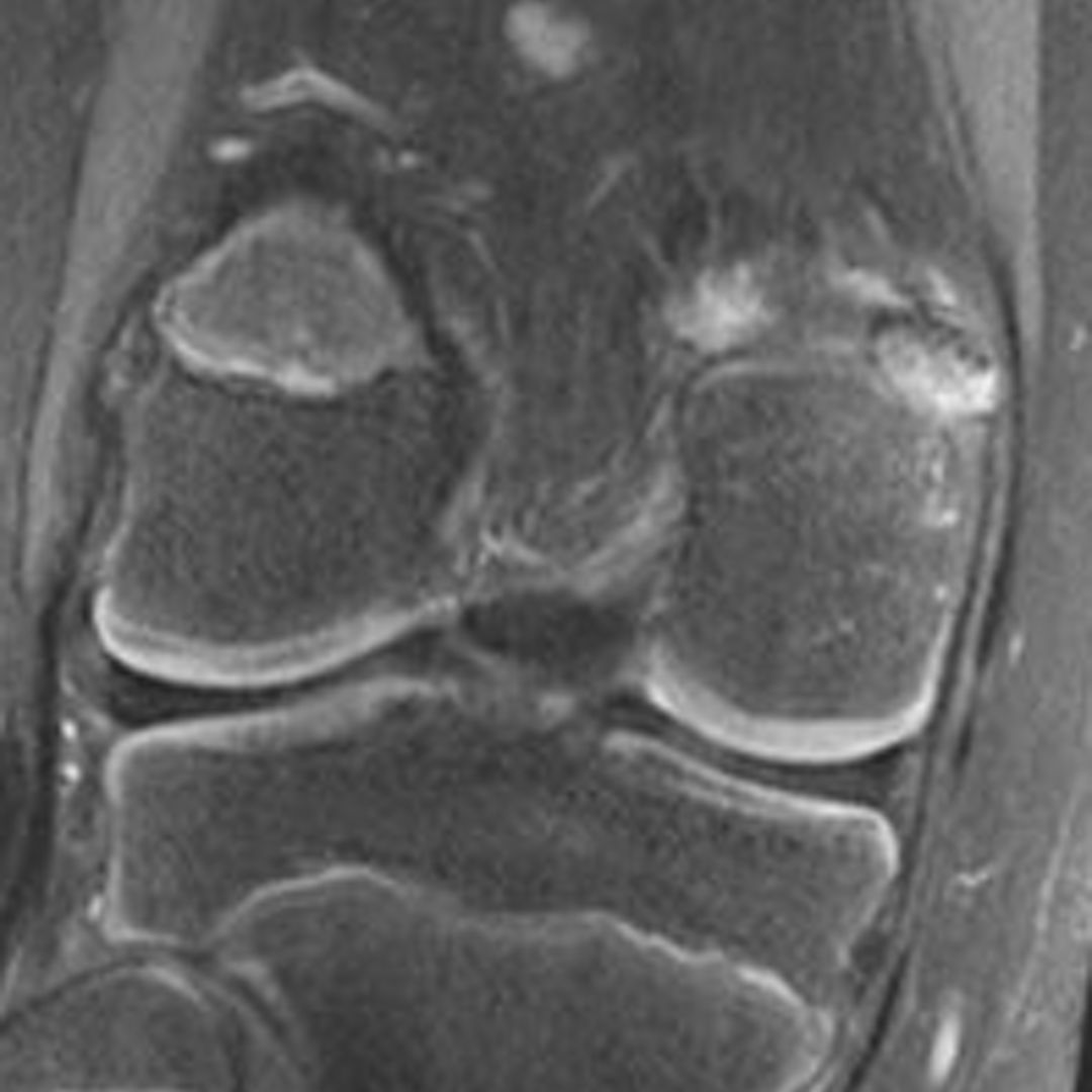 Knee MRI