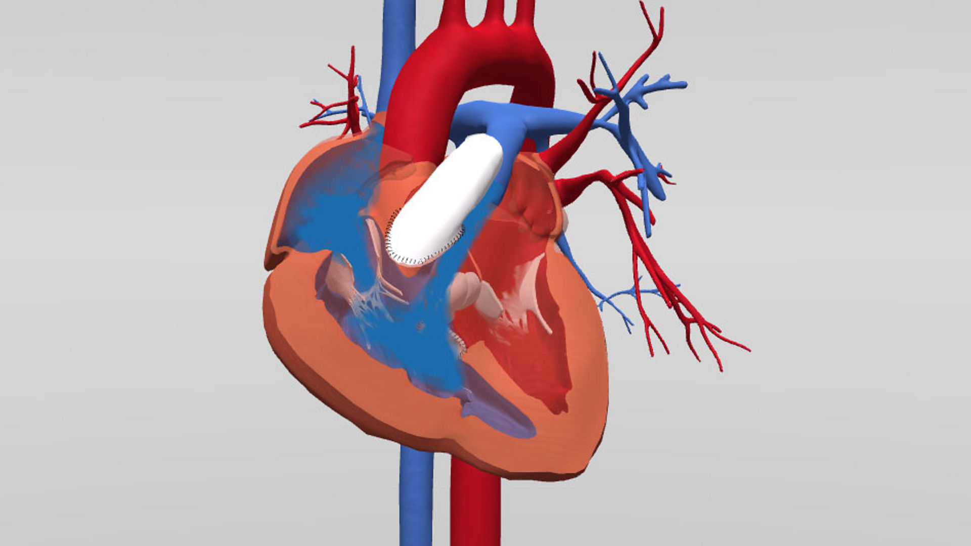 Unifocalización del modelo de corazón 3D